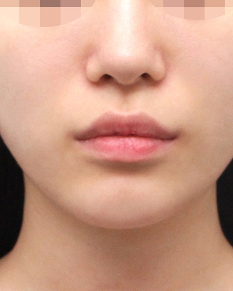 Thread Lifting at Forever Plastic Surgery & Dermatology Gangnam