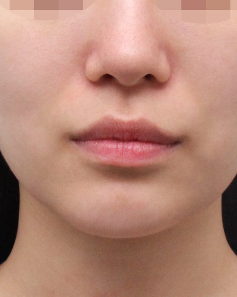 Thread Lifting — before treatment
